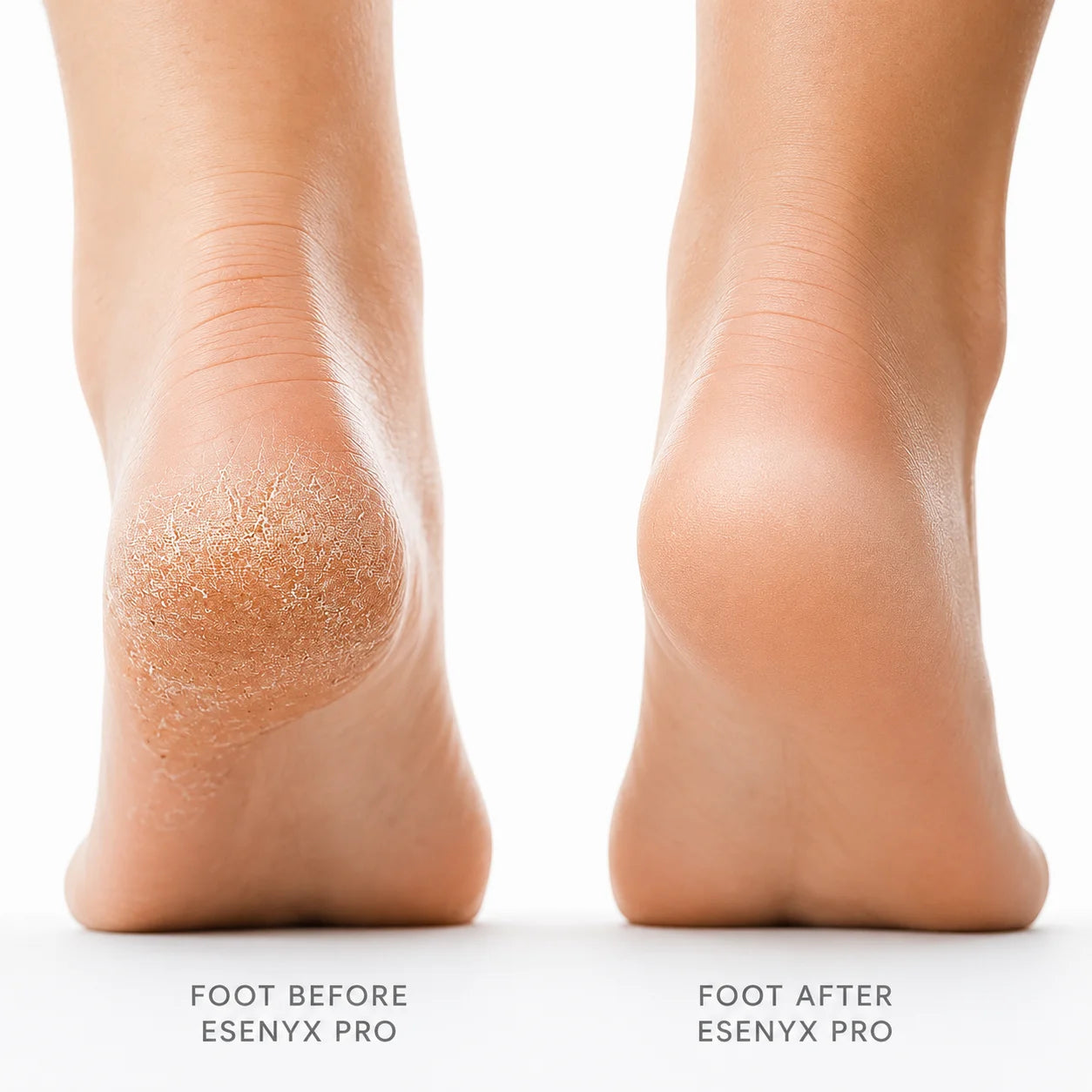 Esenyx Pro Callus Remover